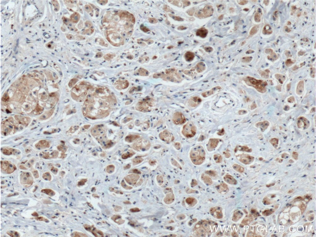 Immunohistochemistry (IHC) staining of human breast cancer tissue using DVL1 Polyclonal antibody (27384-1-AP)