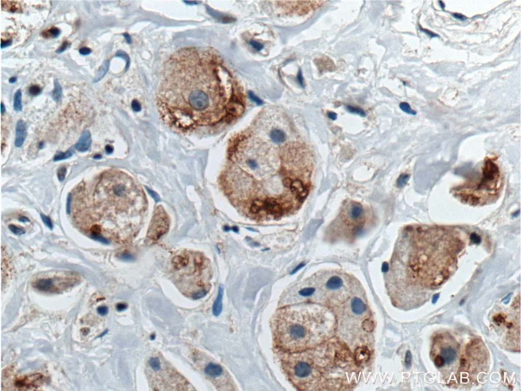 Immunohistochemistry (IHC) staining of human breast cancer tissue using DVL1 Polyclonal antibody (27384-1-AP)