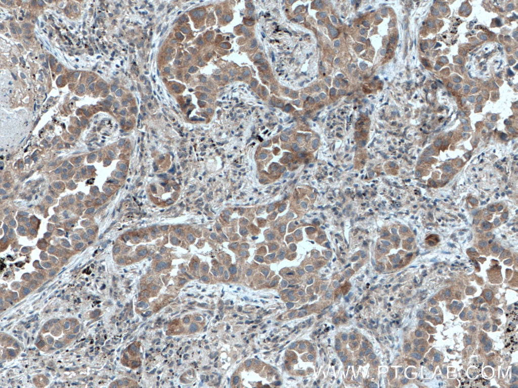 Immunohistochemistry (IHC) staining of human lung cancer tissue using DVL2 Polyclonal antibody (12037-1-AP)
