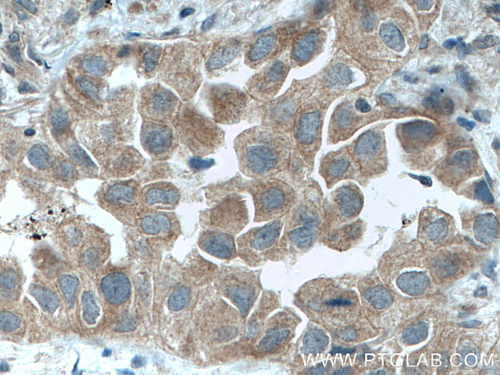 Immunohistochemistry (IHC) staining of human lung cancer tissue using DVL2 Polyclonal antibody (12037-1-AP)