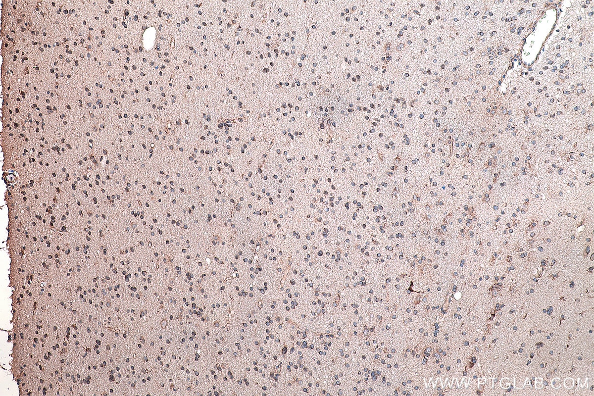 Immunohistochemistry (IHC) staining of human gliomas tissue using DVL2 Polyclonal antibody (12037-1-AP)
