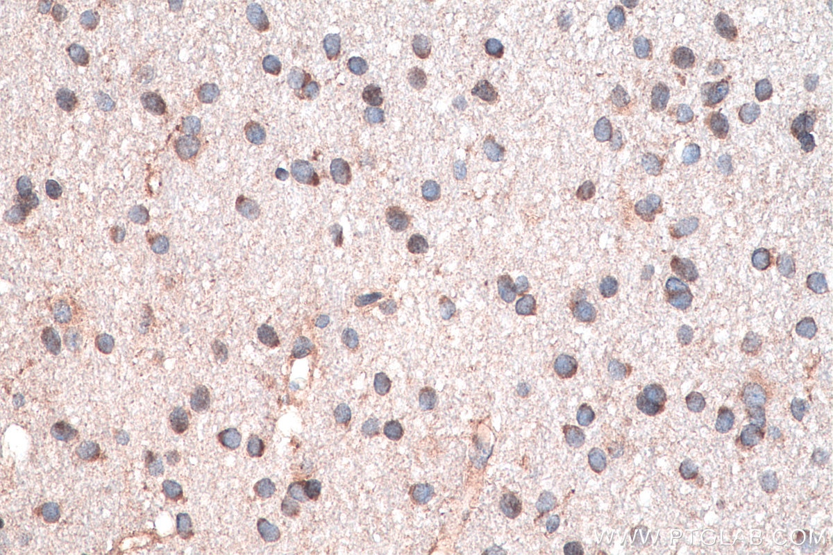 IHC staining of human gliomas using 12037-1-AP