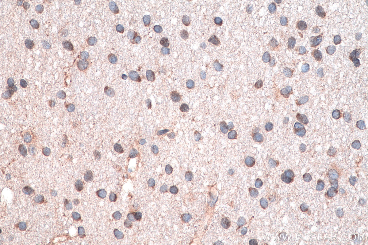 Immunohistochemistry (IHC) staining of human gliomas tissue using DVL2 Polyclonal antibody (12037-1-AP)