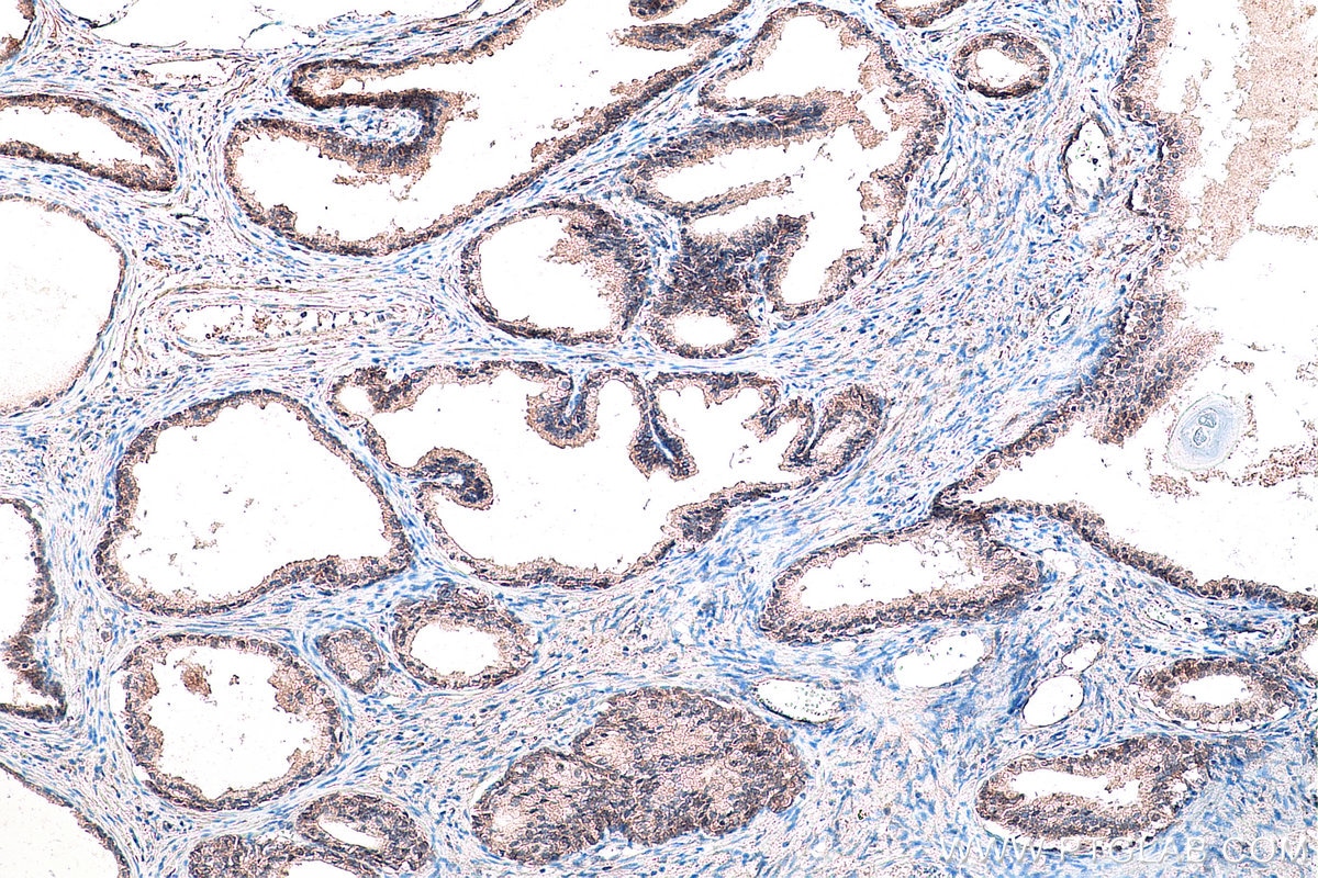 Immunohistochemistry (IHC) staining of human prostate cancer tissue using DVL2 Polyclonal antibody (12037-1-AP)