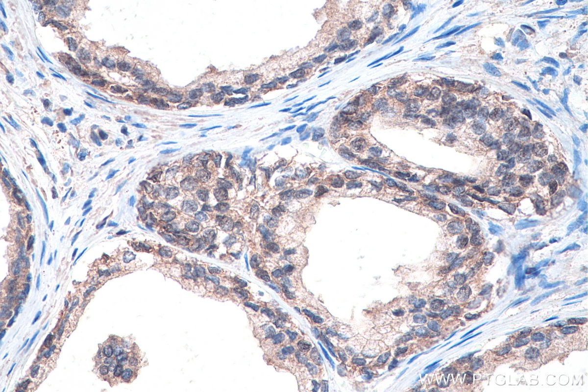 Immunohistochemistry (IHC) staining of human prostate cancer tissue using DVL2 Polyclonal antibody (12037-1-AP)