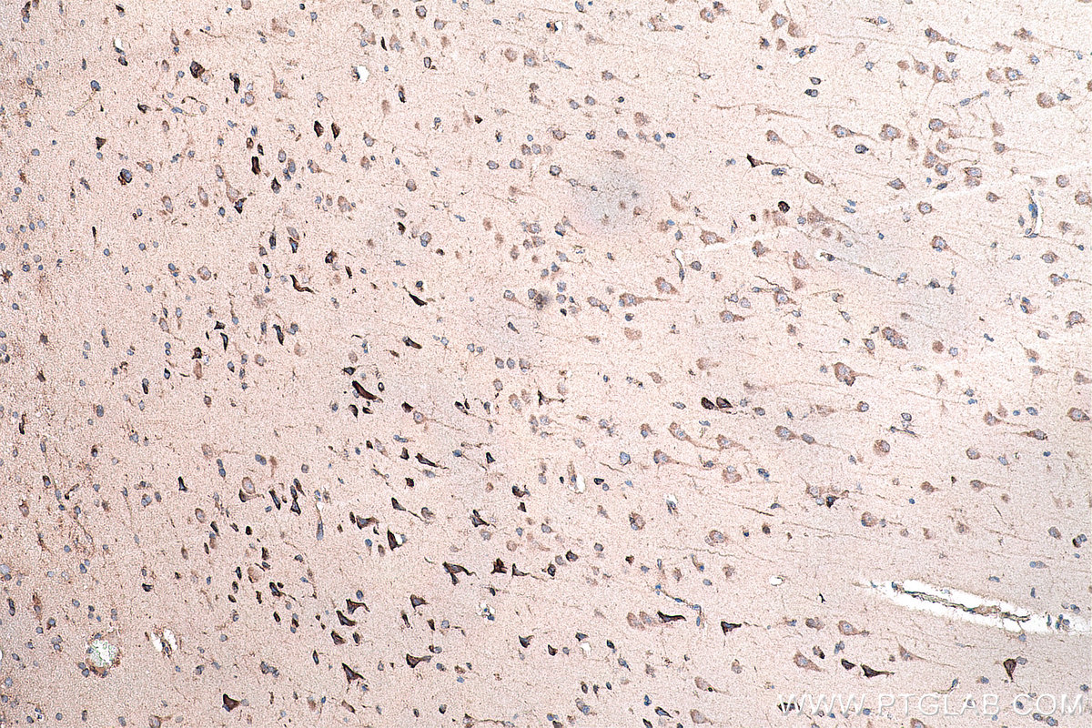 Immunohistochemistry (IHC) staining of human gliomas tissue using DVL2 Polyclonal antibody (12037-1-AP)