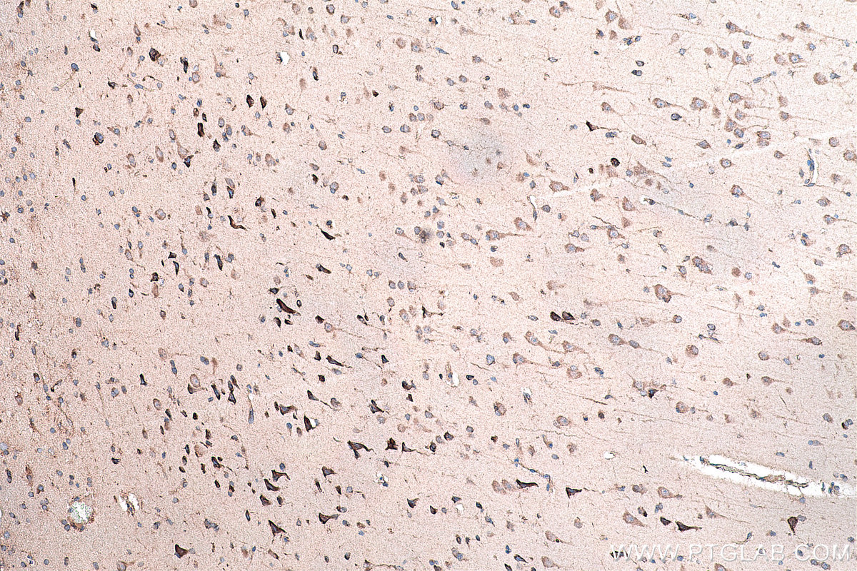 Immunohistochemistry (IHC) staining of human gliomas tissue using DVL2 Polyclonal antibody (12037-1-AP)