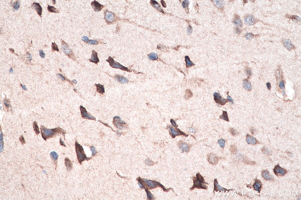 Immunohistochemistry (IHC) staining of human gliomas tissue using DVL2 Polyclonal antibody (12037-1-AP)