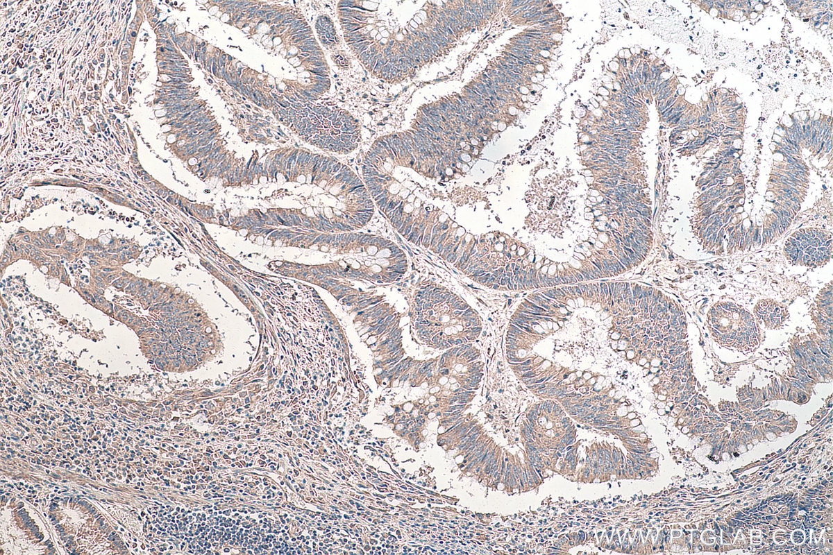 IHC staining of human colon cancer using 67105-1-Ig