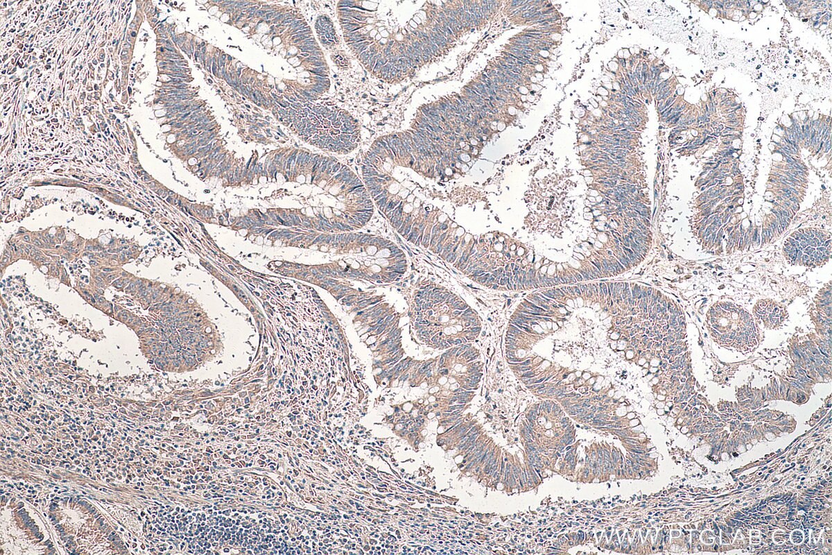 Immunohistochemistry (IHC) staining of human colon cancer tissue using DVL2 Monoclonal antibody (67105-1-Ig)