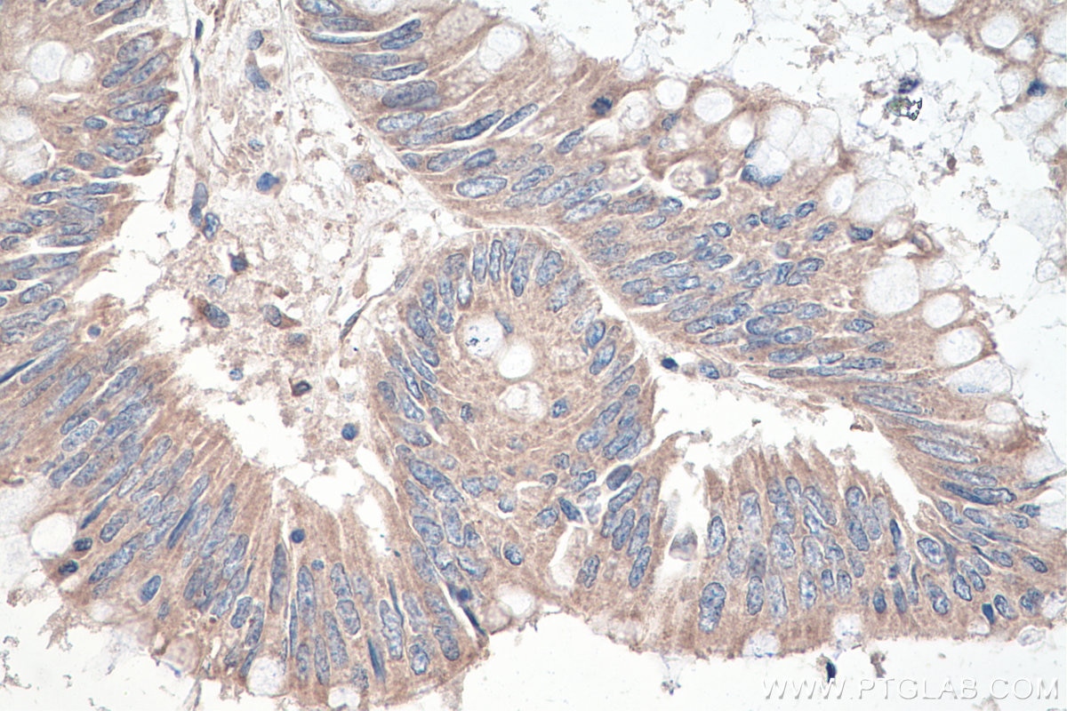 Immunohistochemistry (IHC) staining of human colon cancer tissue using DVL2 Monoclonal antibody (67105-1-Ig)