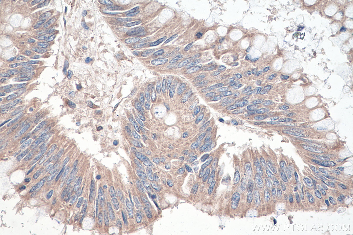 IHC staining of human colon cancer using 67105-1-Ig