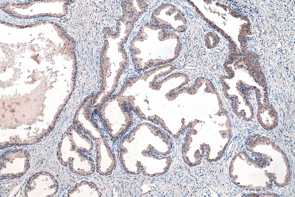 Immunohistochemistry (IHC) staining of human prostate cancer tissue using DVL2 Monoclonal antibody (67105-1-Ig)