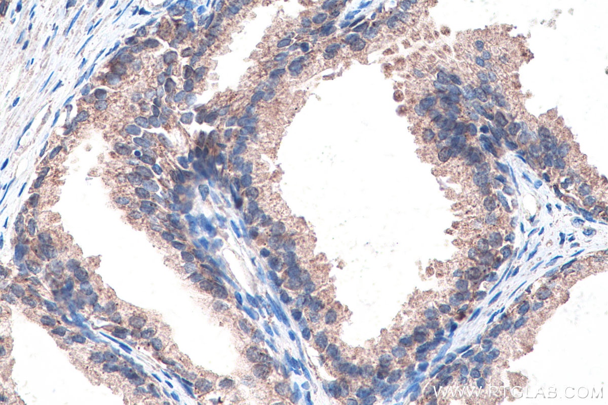 Immunohistochemistry (IHC) staining of human prostate cancer tissue using DVL2 Monoclonal antibody (67105-1-Ig)
