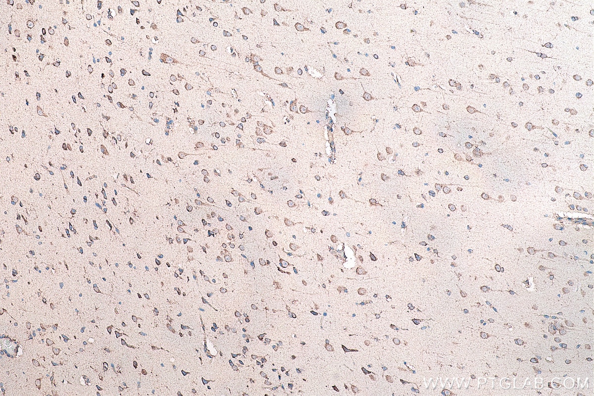 Immunohistochemistry (IHC) staining of human gliomas tissue using DVL2 Monoclonal antibody (67105-1-Ig)