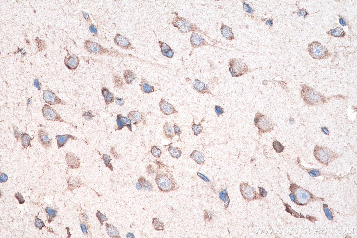 Immunohistochemistry (IHC) staining of human gliomas tissue using DVL2 Monoclonal antibody (67105-1-Ig)