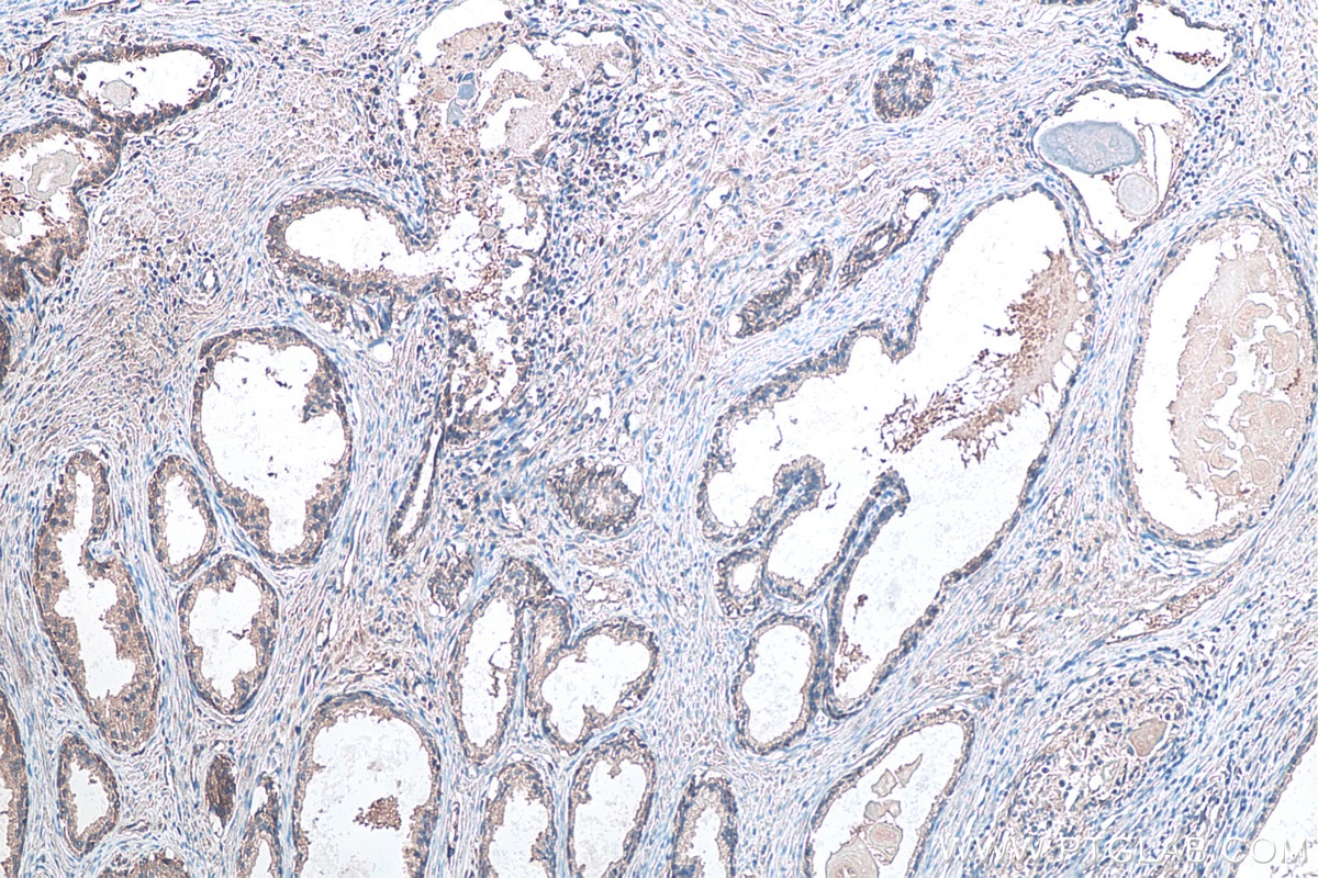 Immunohistochemistry (IHC) staining of human prostate cancer tissue using DVL3 Polyclonal antibody (13444-1-AP)