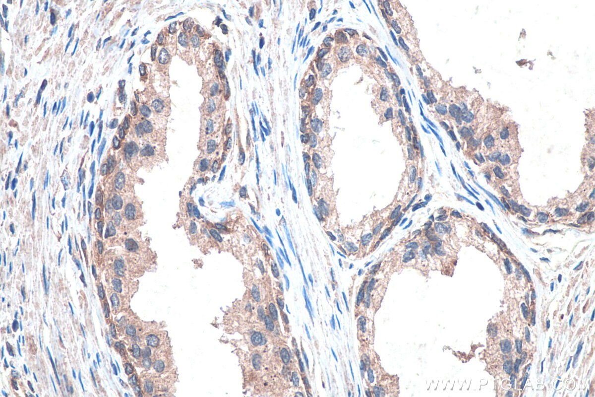 IHC staining of human prostate cancer using 13444-1-AP