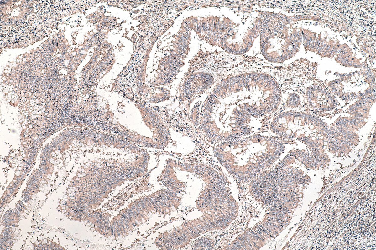 Immunohistochemistry (IHC) staining of human colon cancer tissue using DVL3 Polyclonal antibody (13444-1-AP)