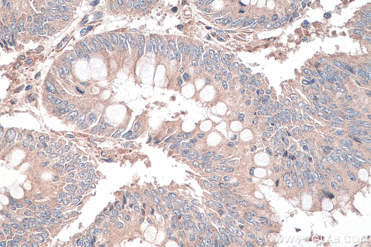 Immunohistochemistry (IHC) staining of human colon cancer tissue using DVL3 Polyclonal antibody (13444-1-AP)