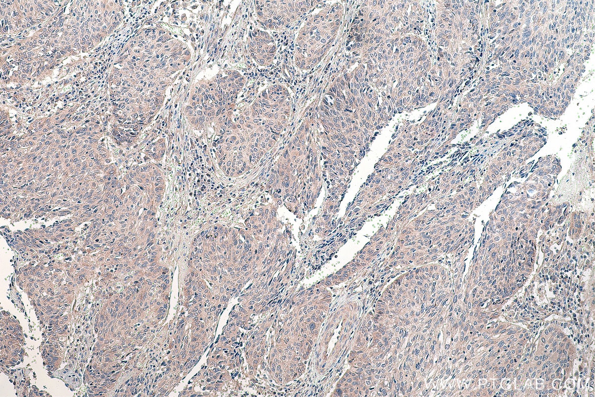 Immunohistochemistry (IHC) staining of human cervical cancer tissue using DVL3 Polyclonal antibody (13444-1-AP)