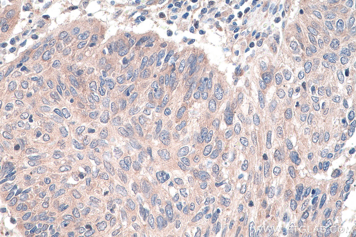 Immunohistochemistry (IHC) staining of human cervical cancer tissue using DVL3 Polyclonal antibody (13444-1-AP)