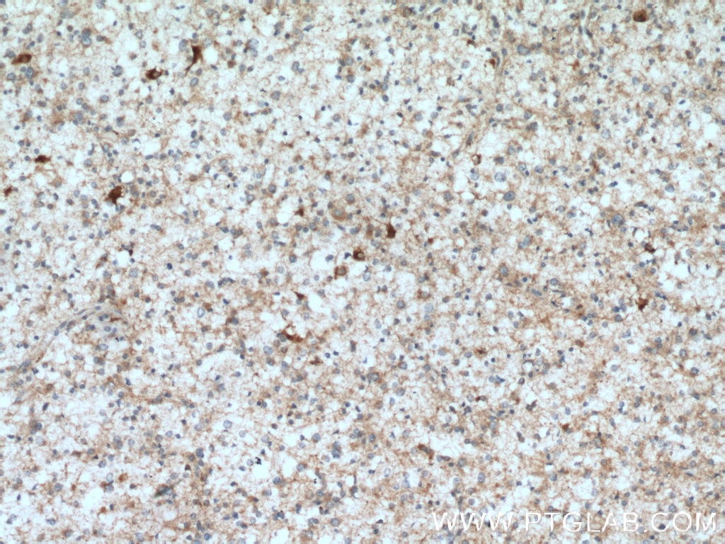 Immunohistochemistry (IHC) staining of human gliomas tissue using DYNC1I1 Polyclonal antibody (13808-1-AP)