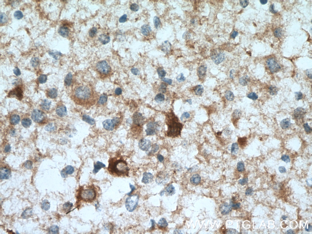 IHC staining of human gliomas using 13808-1-AP