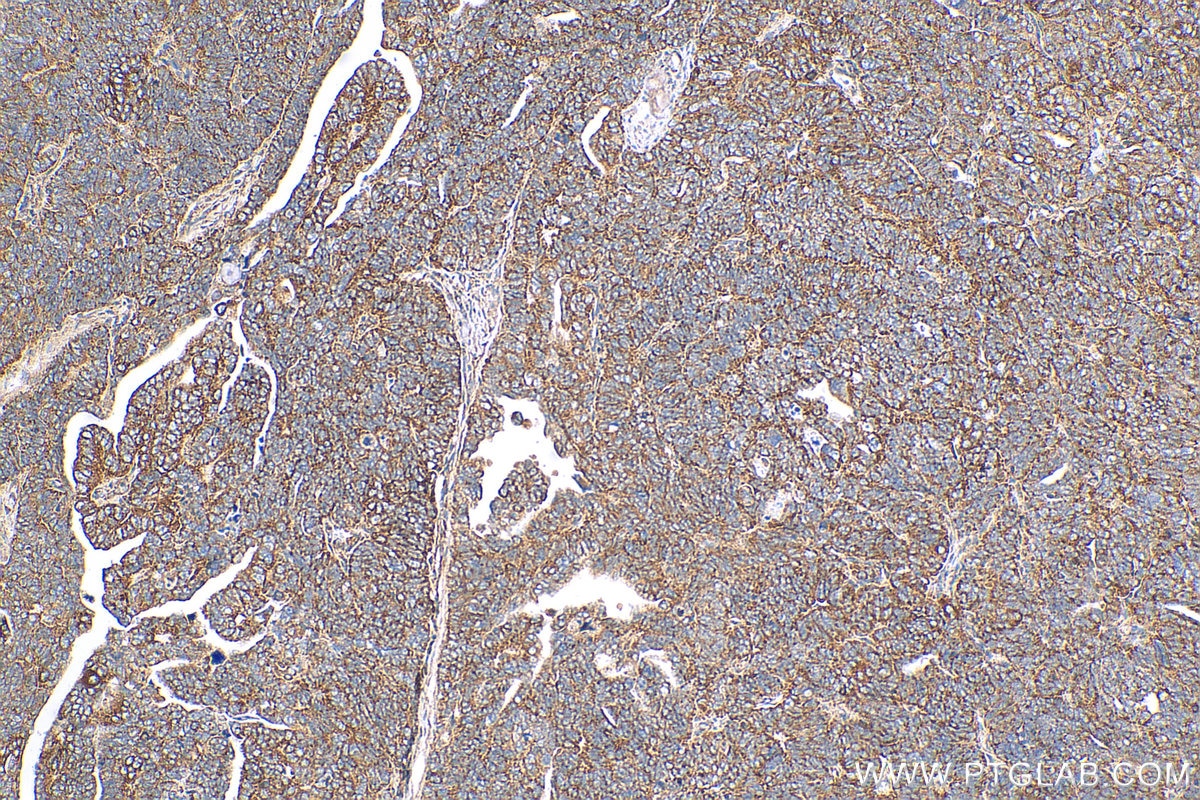 Immunohistochemistry (IHC) staining of human ovary tumor tissue using DYNLT3 Polyclonal antibody (11687-1-AP)