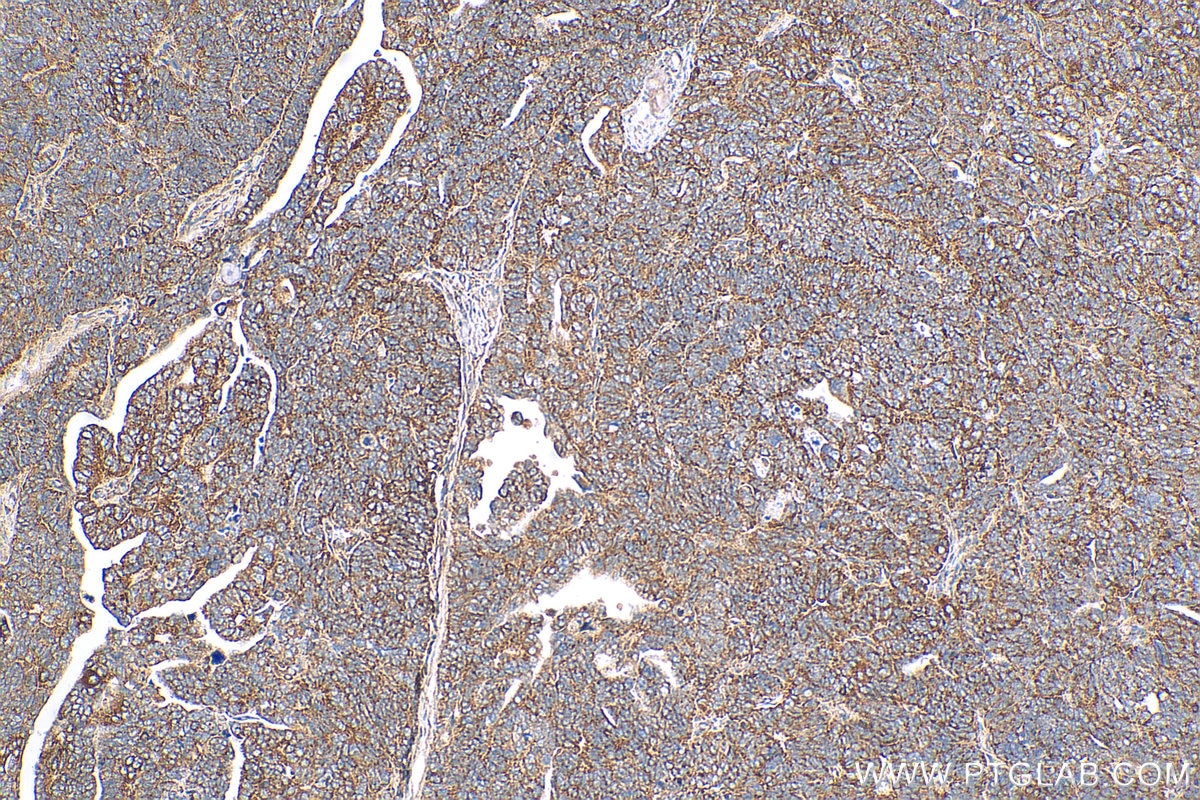 IHC staining of human ovary tumor using 11687-1-AP