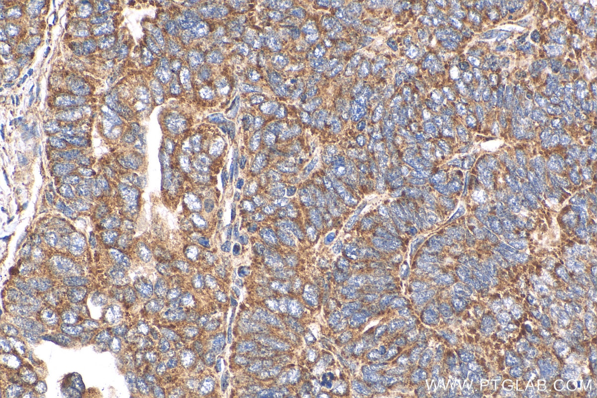 Immunohistochemistry (IHC) staining of human ovary tumor tissue using DYNLT3 Polyclonal antibody (11687-1-AP)