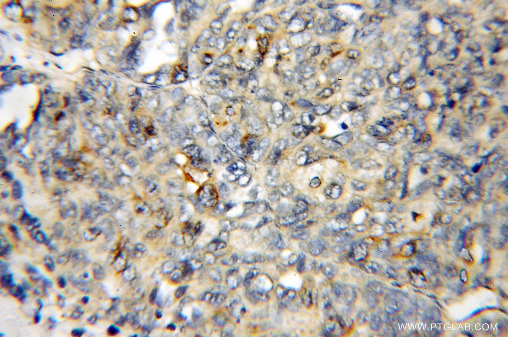Immunohistochemistry (IHC) staining of human ovary tumor tissue using DYNLT3 Polyclonal antibody (11687-1-AP)