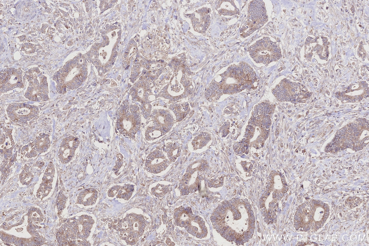 IHC staining of human rectal cancer using 21979-1-AP Immunohistochemistry (IHC) staining of human rectal cancer tissue using DYRK2 Polyclonal antibody (21979-1-AP)