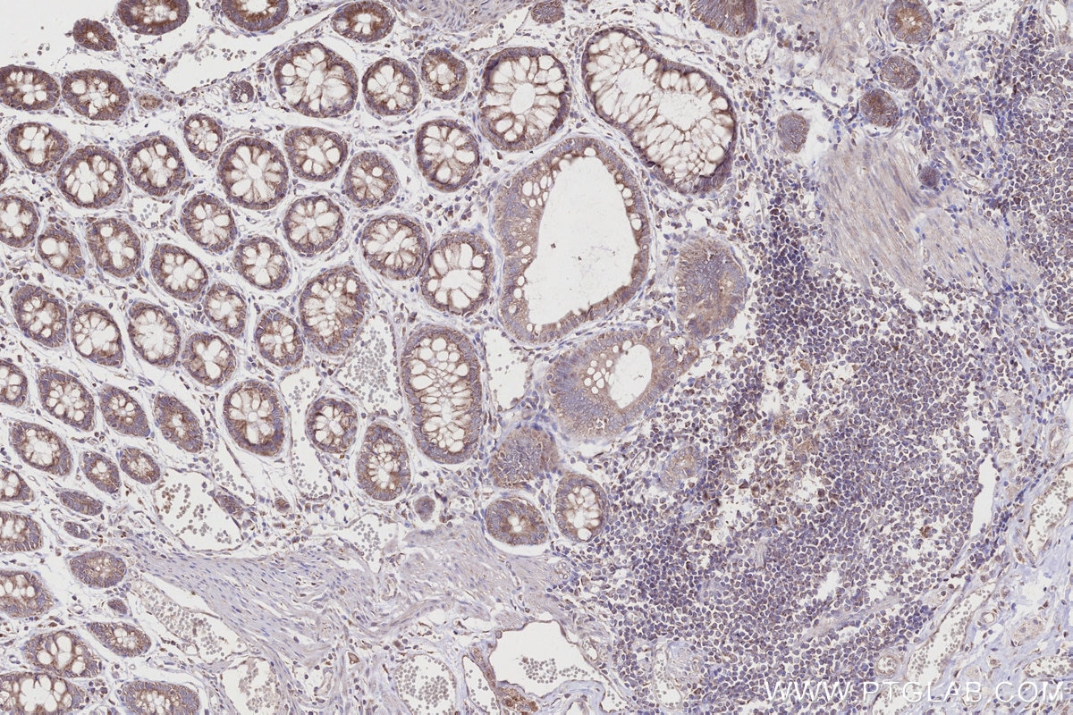 IHC staining of human rectal cancer using 21979-1-AP Immunohistochemistry (IHC) staining of human rectal cancer tissue using DYRK2 Polyclonal antibody (21979-1-AP)