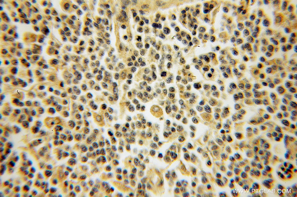 Immunohistochemistry (IHC) staining of human lymphoma tissue using DYRK4 Polyclonal antibody (12890-2-AP)