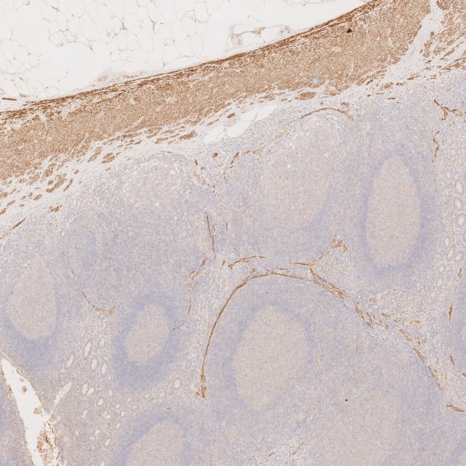 IHC staining of human appendicitis using 67793-1-Ig Immunohistochemistry (IHC) staining of human appendicitis tissue using Desmin Monoclonal antibody (67793-1-Ig)