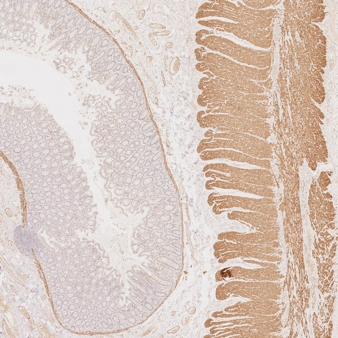 IHC staining of human colorectal cancer using 67793-1-Ig Immunohistochemistry (IHC) staining of human colorectal cancer tissue using Desmin Monoclonal antibody (67793-1-Ig)