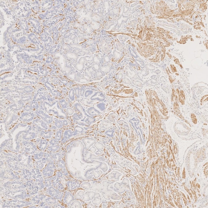 IHC staining of human stomach cancer using 67793-1-Ig Immunohistochemistry (IHC) staining of human stomach cancer tissue using Desmin Monoclonal antibody (67793-1-Ig)