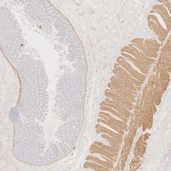 IHC staining of human colorectal cancer using 67793-1-Ig Immunohistochemistry (IHC) staining of human colorectal cancer tissue using Desmin Monoclonal antibody (67793-1-Ig)