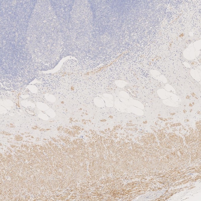 IHC staining of human appendicitis using 67793-1-Ig Immunohistochemistry (IHC) staining of human appendicitis tissue using Desmin Monoclonal antibody (67793-1-Ig)