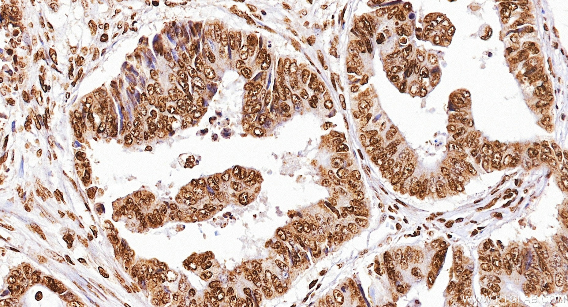 IHC staining of human colon cancer using 86990-2-RR (same clone as 86990-2-PBS) Immunohistochemistry (IHC) staining of human colon cancer tissue using Di-Methyl-Histone H3 (Lys9) Recombinant monoclonal (86990-2-RR)