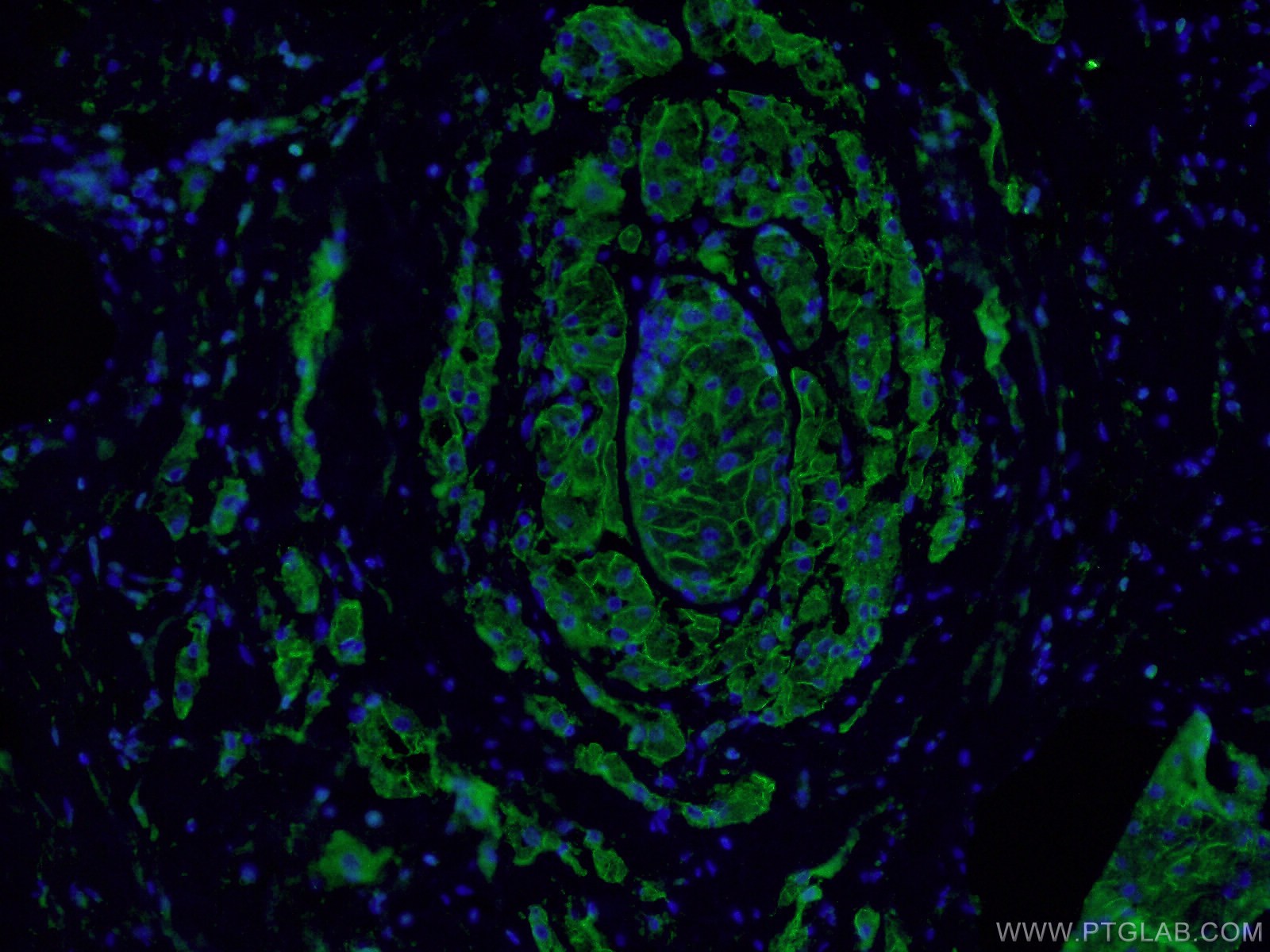 Immunofluorescence (IF) / fluorescent staining of human breast cancer tissue using E-cadherin Polyclonal antibody (20874-1-AP)