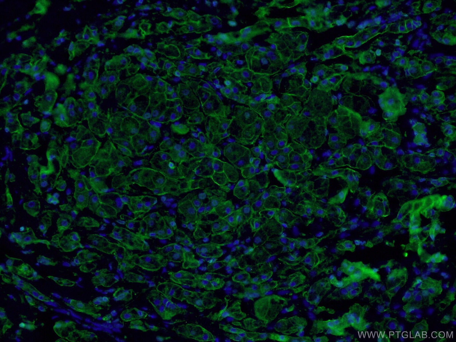 Immunofluorescence (IF) / fluorescent staining of human breast cancer tissue using E-cadherin Polyclonal antibody (20874-1-AP)