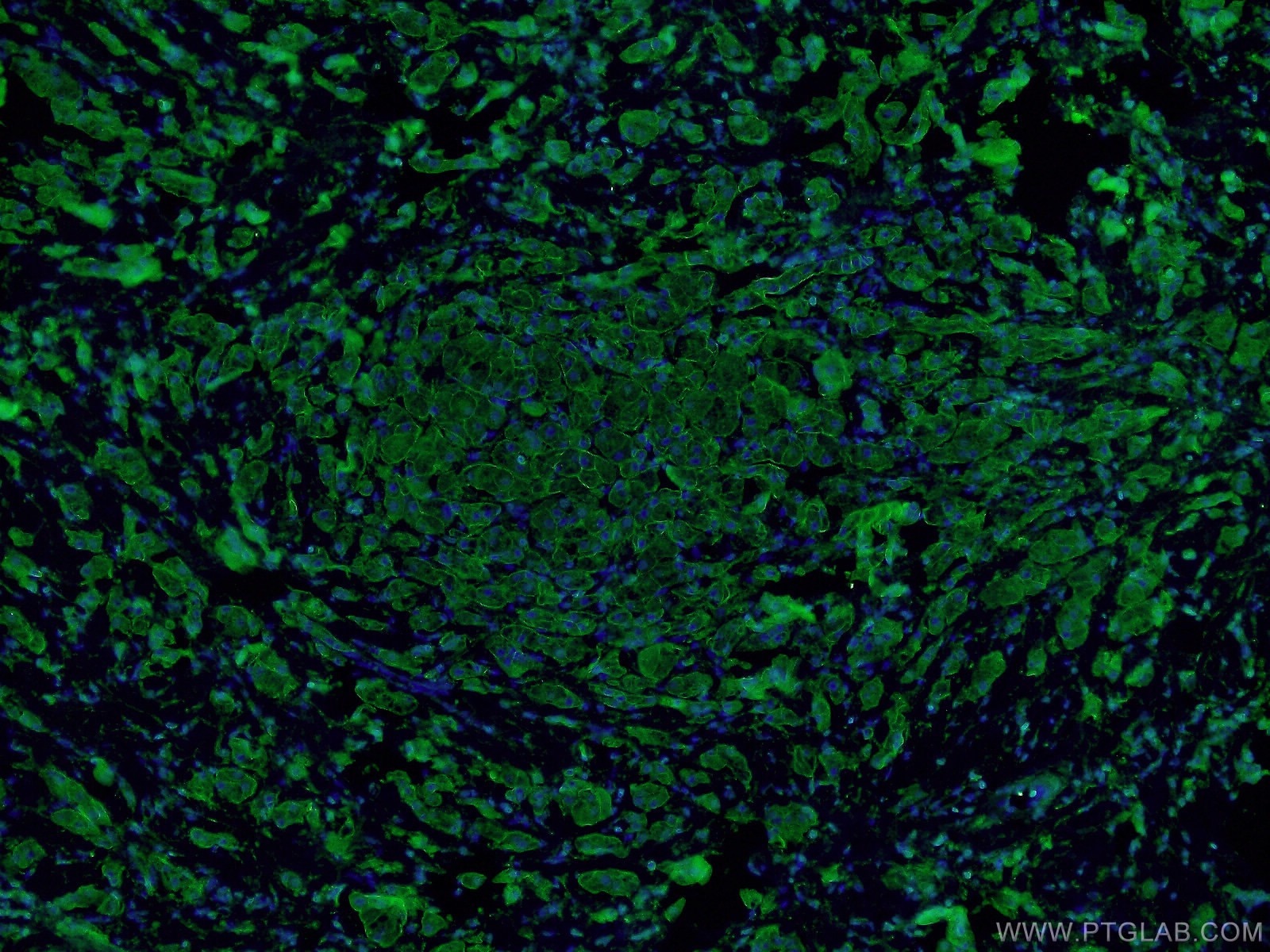 Immunofluorescence (IF) / fluorescent staining of human breast cancer tissue using E-cadherin Polyclonal antibody (20874-1-AP)