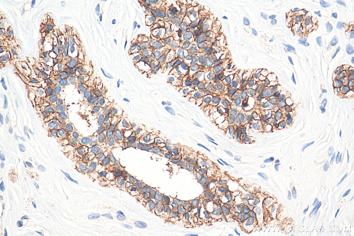 Immunohistochemistry (IHC) staining of human breast cancer tissue using E-cadherin Polyclonal antibody (20874-1-AP)