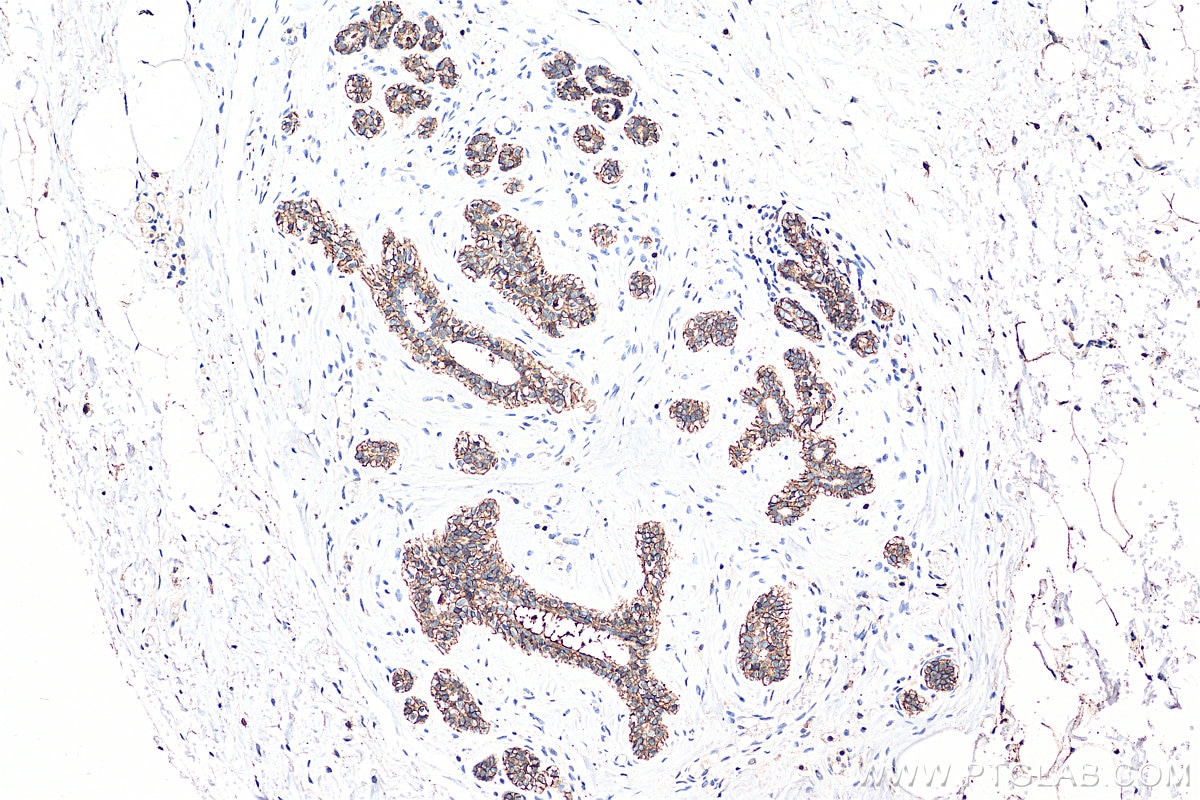 IHC staining of human breast cancer using 20874-1-AP