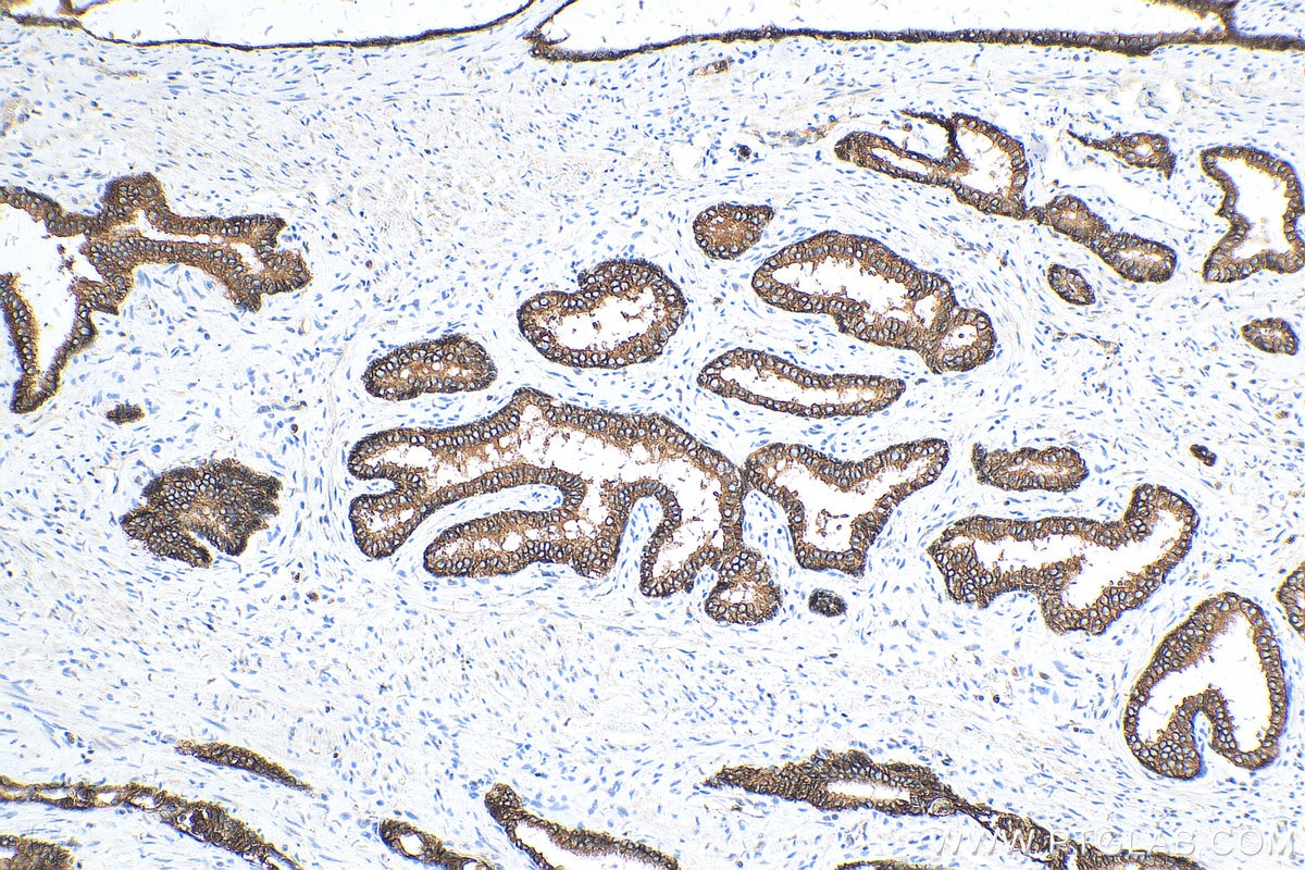 Immunohistochemistry (IHC) staining of human prostate cancer tissue using E-cadherin Polyclonal antibody (20874-1-AP)