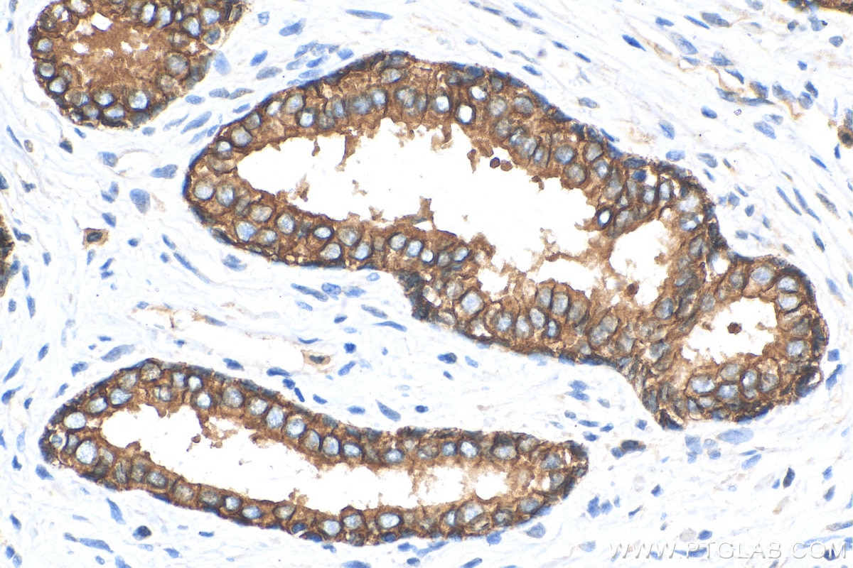 Immunohistochemistry (IHC) staining of human prostate cancer tissue using E-cadherin Polyclonal antibody (20874-1-AP)