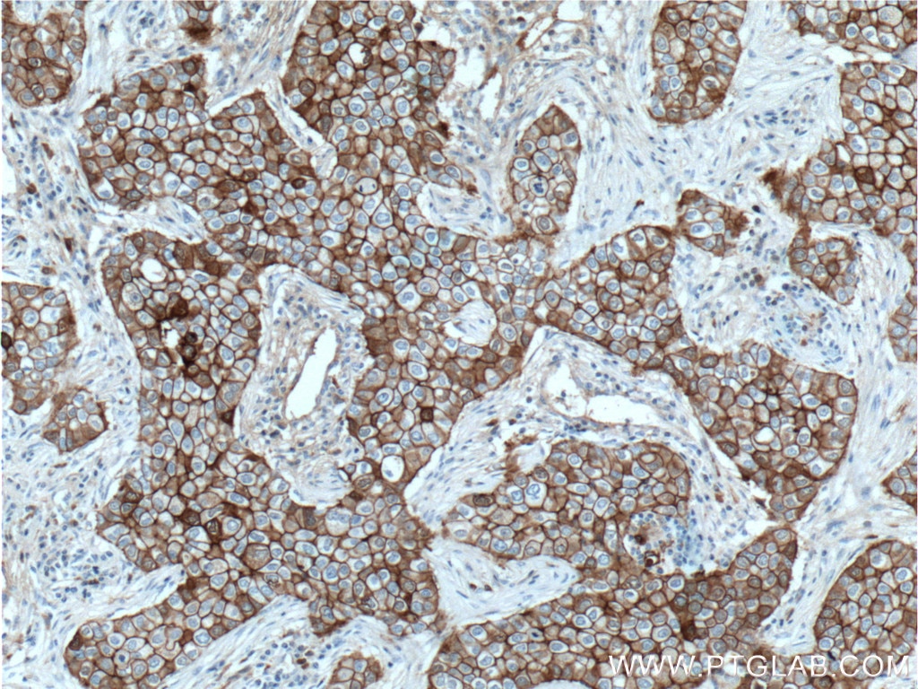 Immunohistochemistry (IHC) staining of human breast cancer tissue using E-cadherin Monoclonal antibody (60335-1-Ig)