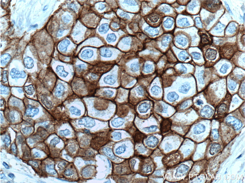 Immunohistochemistry (IHC) staining of human breast cancer tissue using E-cadherin Monoclonal antibody (60335-1-Ig)